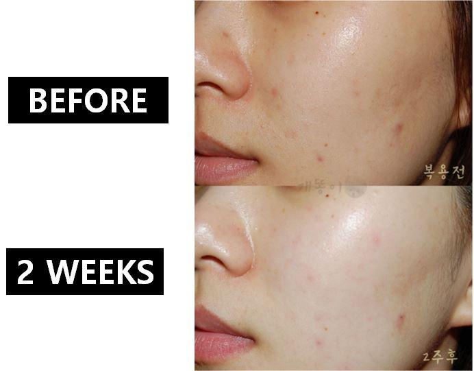 (พรีออเดอร์รอของ 10-14 วัน ) Inner B Collagen อินเนอร์บีคลอลาเจน ช่วยให้ผิวเด้ง อิ่มน้ำสุดๆ ช่วยลดจุดด่างดำ กระชับรูขุมขน สั่งเยอะเกิน 6 กระปุ๊กมีแถมฟรีคะ