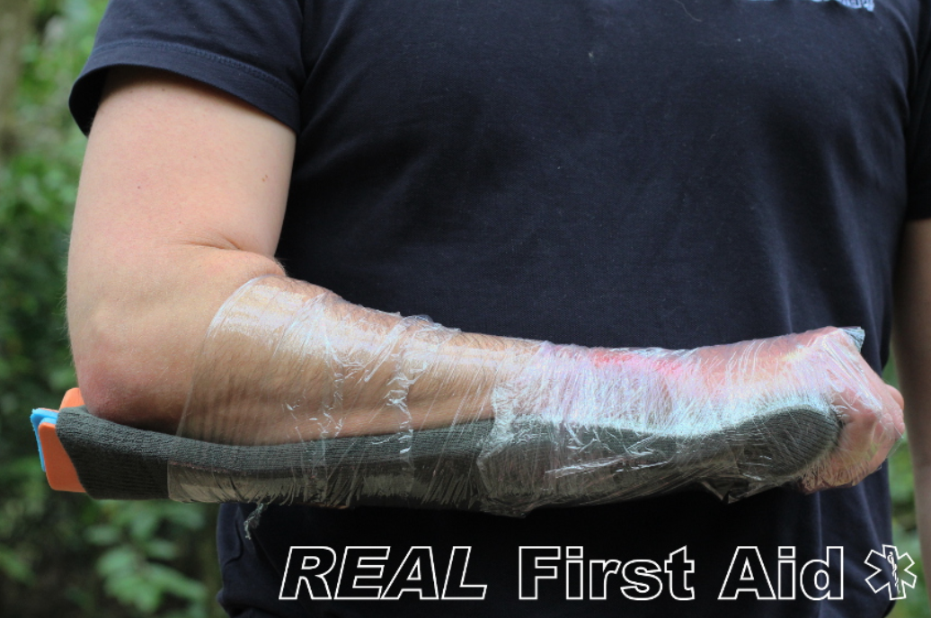 aluminum splint roll (ขนาด 11 x 46 cm.)