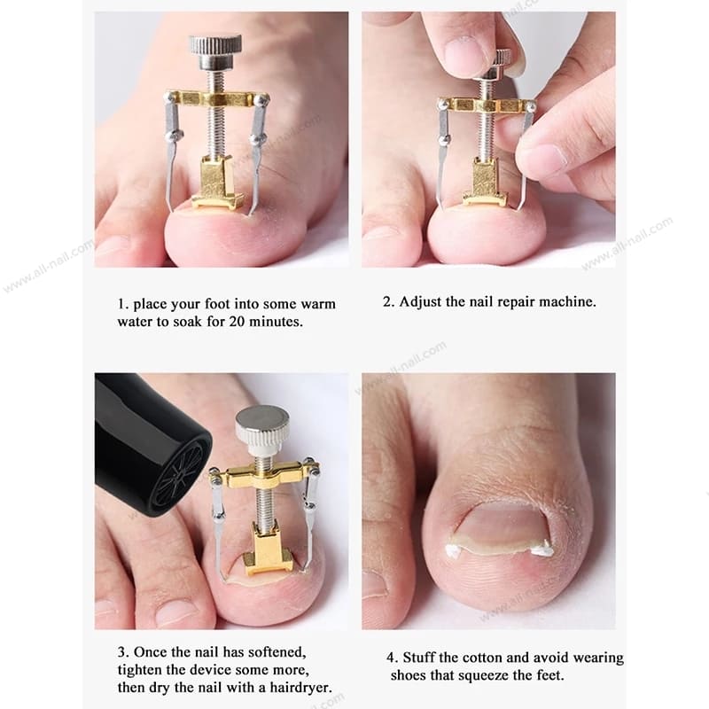 ที่งัดเล็บขบ อุปกรณ์งัดเล็บขบ ตัวช่วยง้างรักษาเล็บขบ