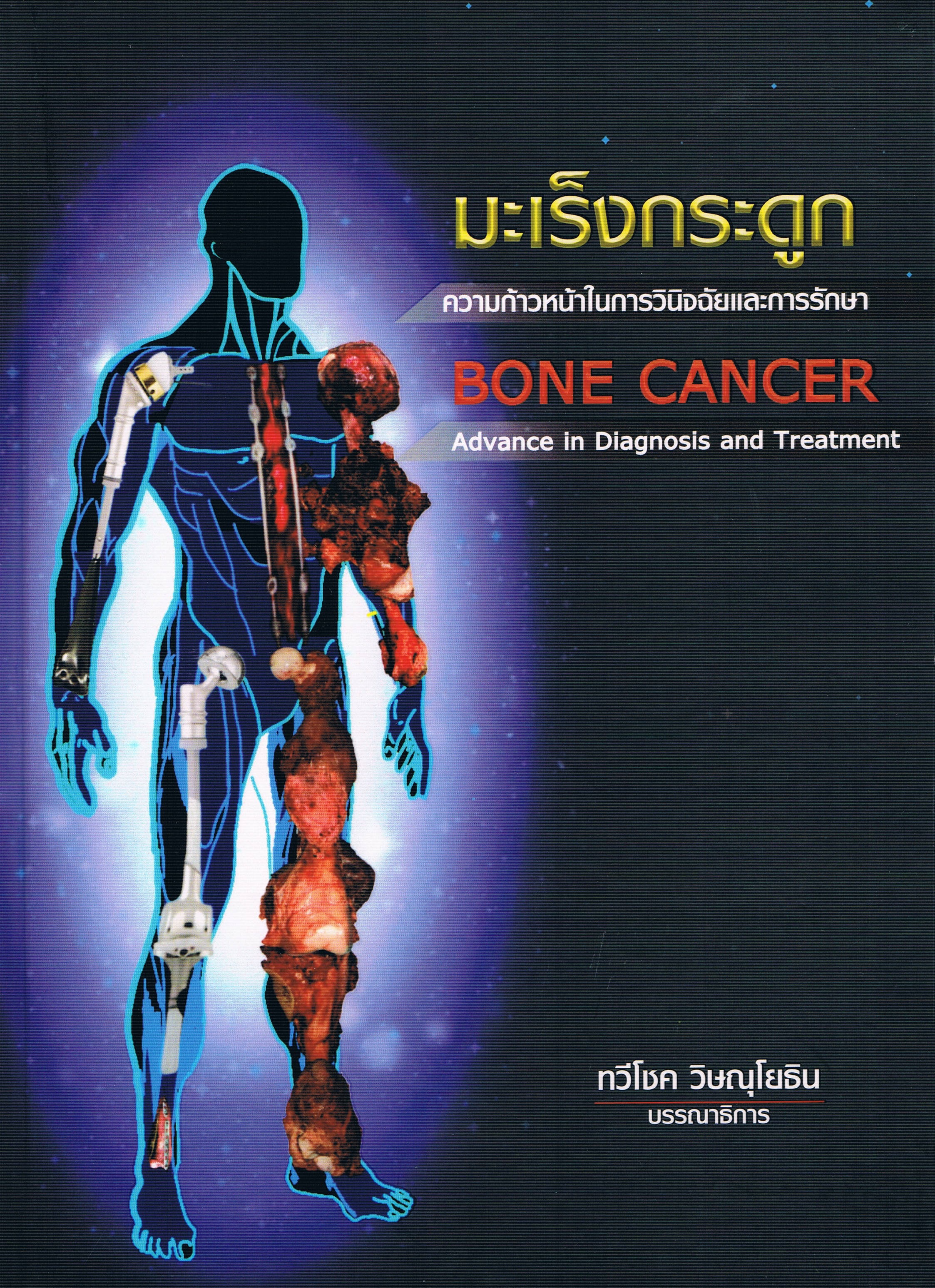 มะเร็งกระดูก ความก้าวหน้าในการวินิจฉัยและการรักษา BONE CANCER Advance in Diagnosis and Treatment