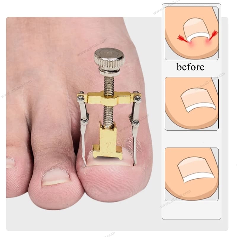ที่งัดเล็บขบ อุปกรณ์งัดเล็บขบ ตัวช่วยง้างรักษาเล็บขบ